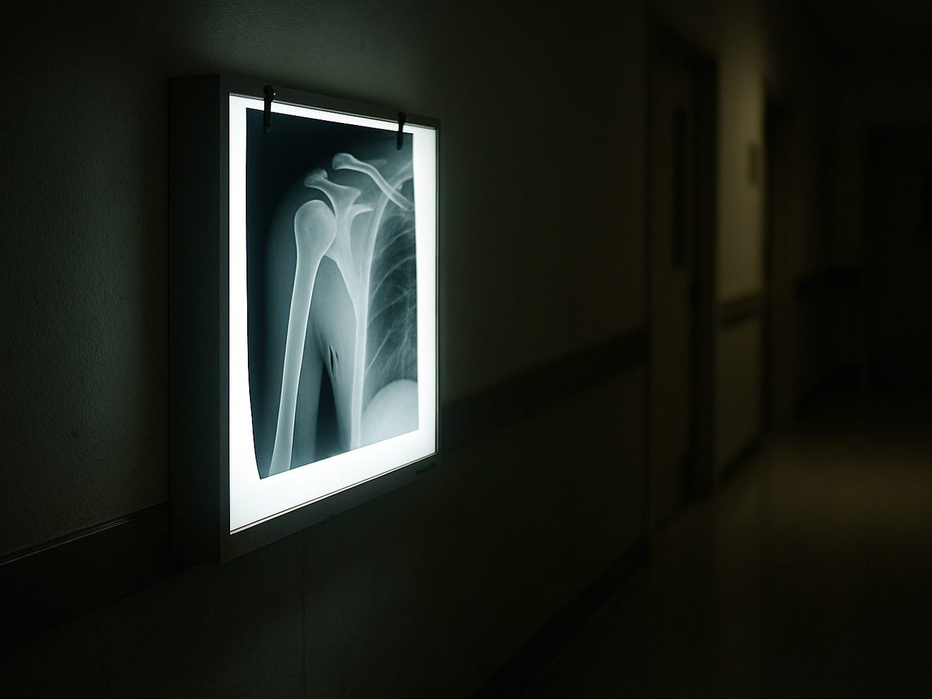 A wall-mounted lightbox in a dim clinic hallway with a radiograph of a shoulder joint clipped to it.